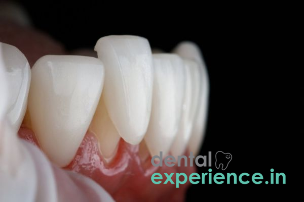 8 Surprising Facts About Dental Veneers!
