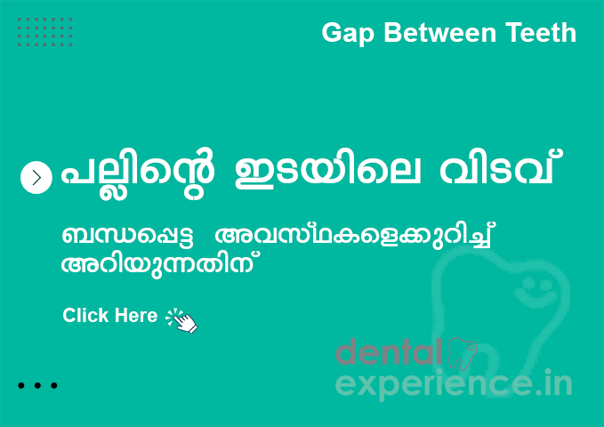Gap Between Teeth