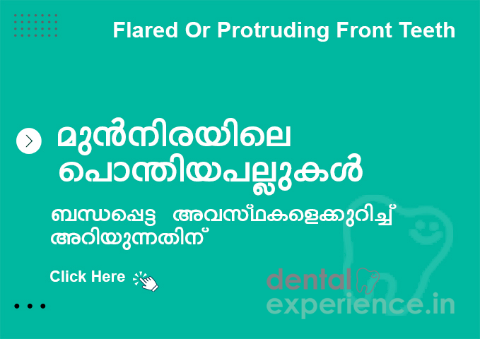 Flared Or Protruding Front Teeth
